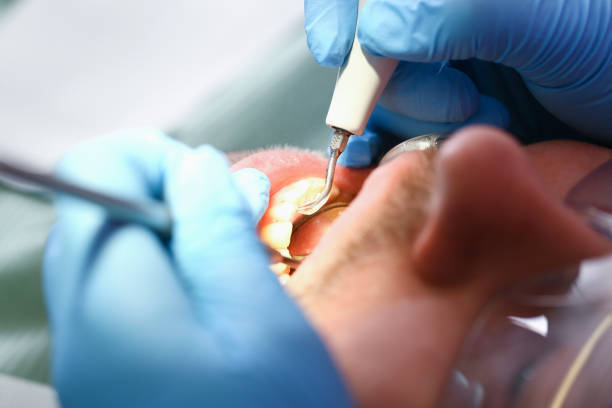 Best Emergency Dental Care for Broken or Chipped Teeth in Madison, MS